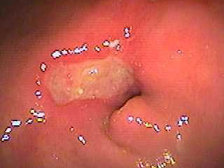 gastric ulcer on P-ring