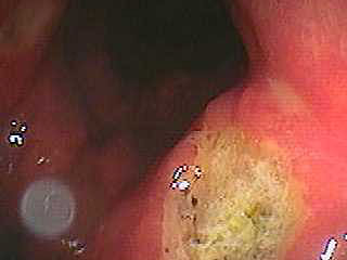 gastric ulcer on corps